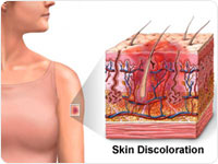 skin discoloration