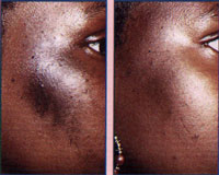 Melasma (Mask of Pregnancy)