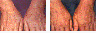 Brown spots on hands